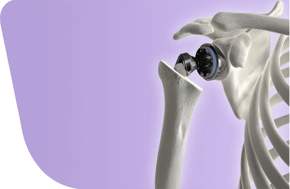 Shoulder Arthroplasty