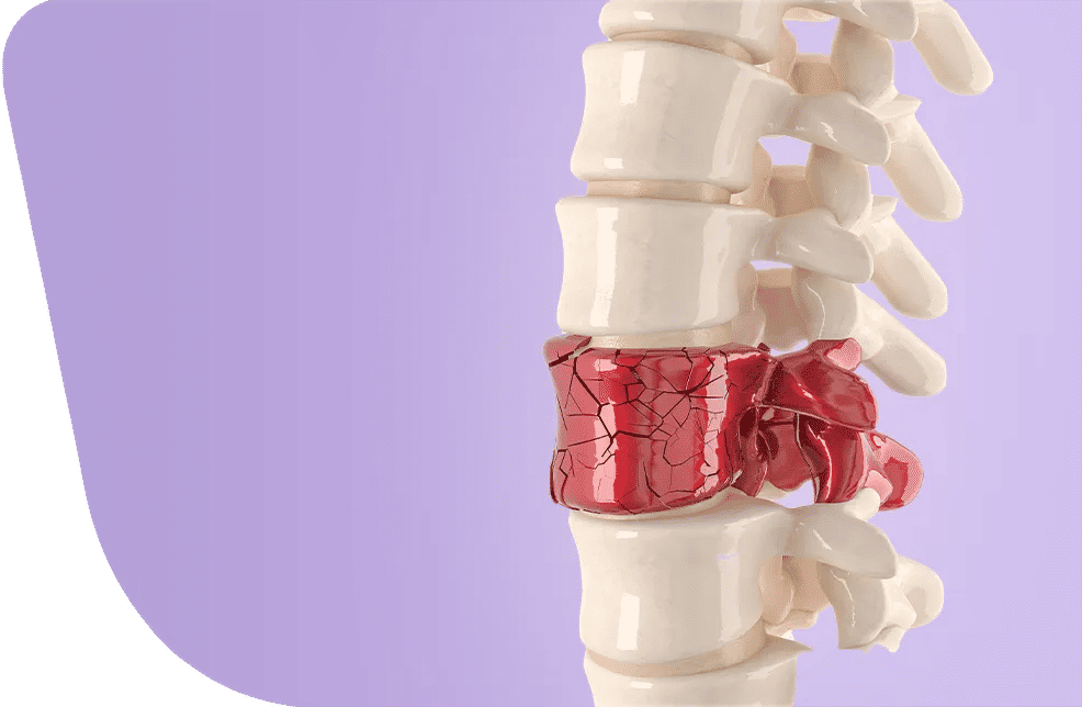Chirurgie des fractures vertébrales
