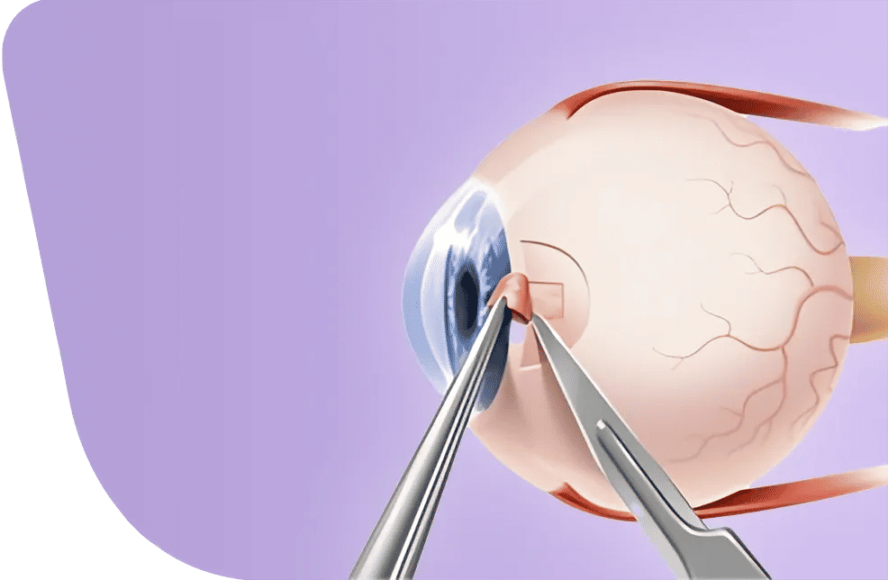 Glaucoma Surgery