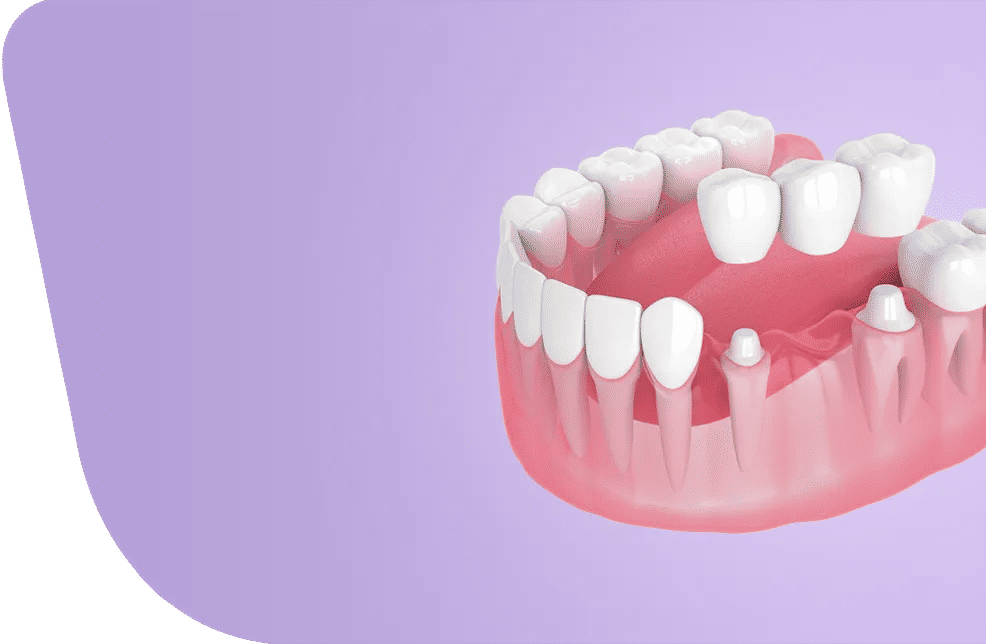 Dental Bridge