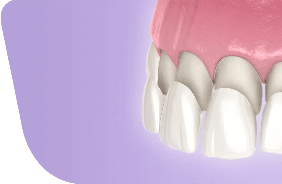 Dental Veneers 