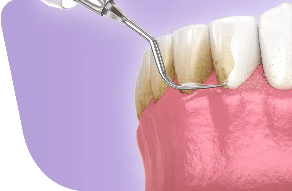 Dental Deep Cleaning