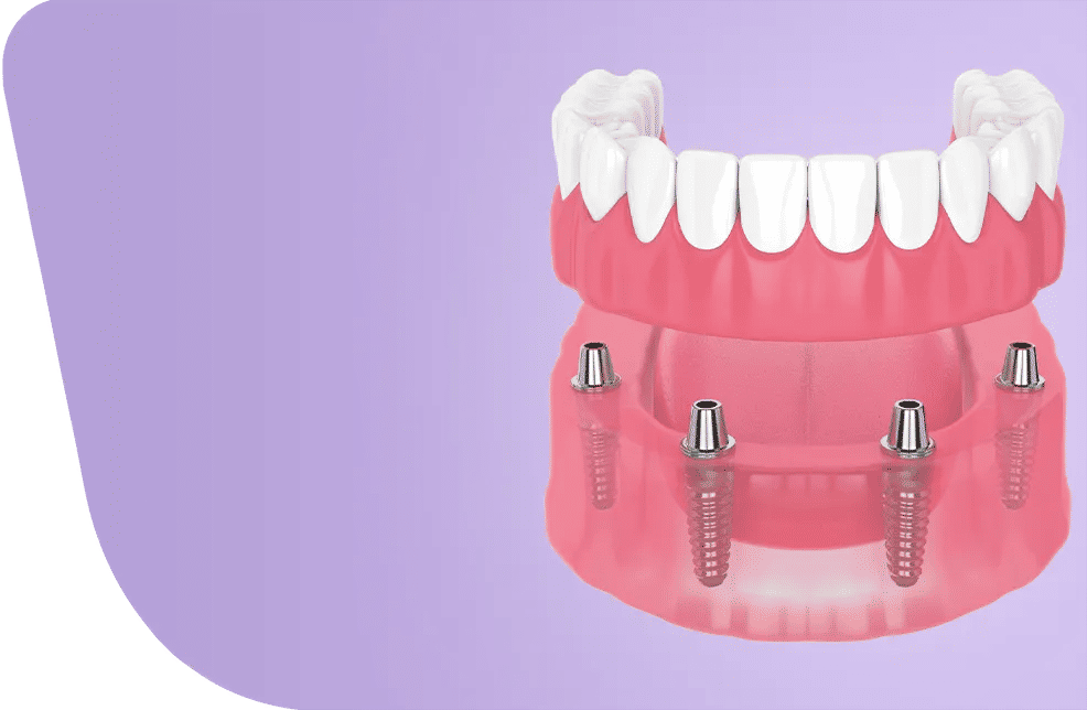 Full Mouth Dental Implants