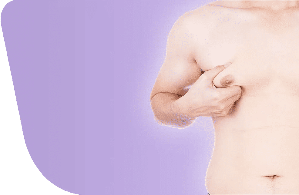 إزالة التثدي عند الرجال 