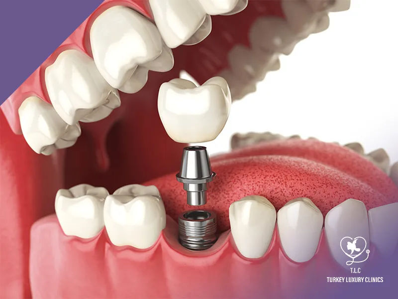 Blanchiment des dents – technologie Zoom