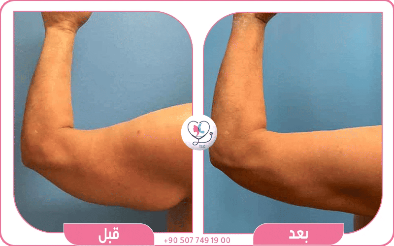 نتائج شد الذراعين قبل وبعد