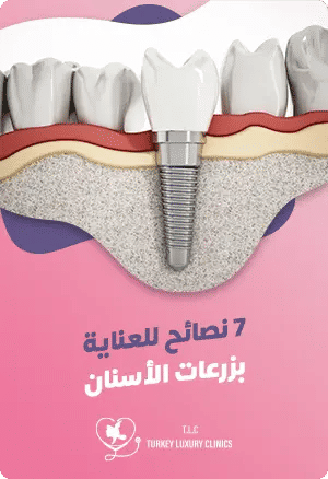 7 تعليمات بعد زراعة الأسنانfeatured image