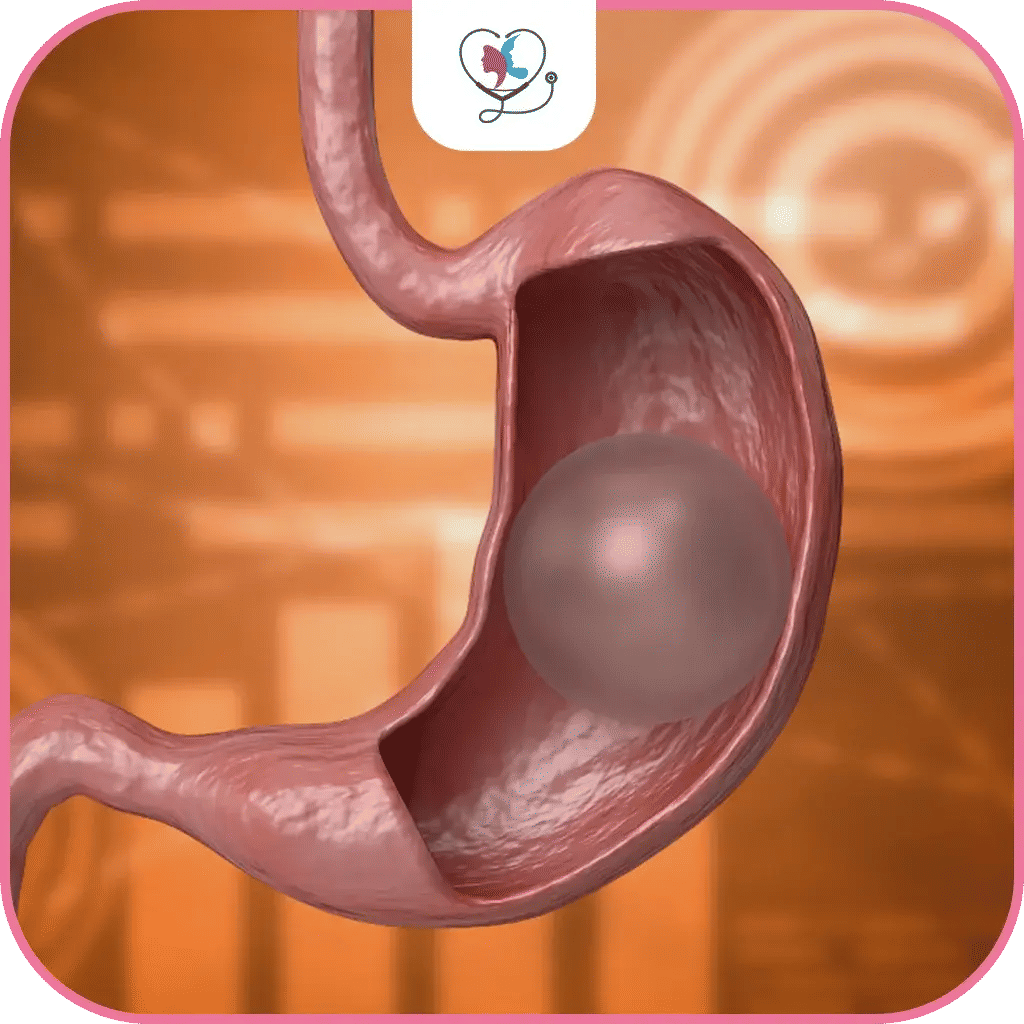 بالون المعدة في تركيا .. ماهو؟ وكيف يعمل؟