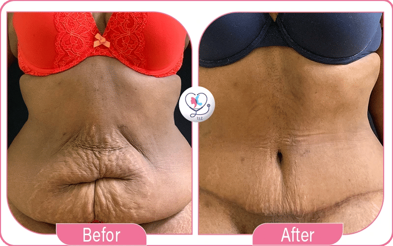 Before and After Tummy Tuck Belly Button Scar