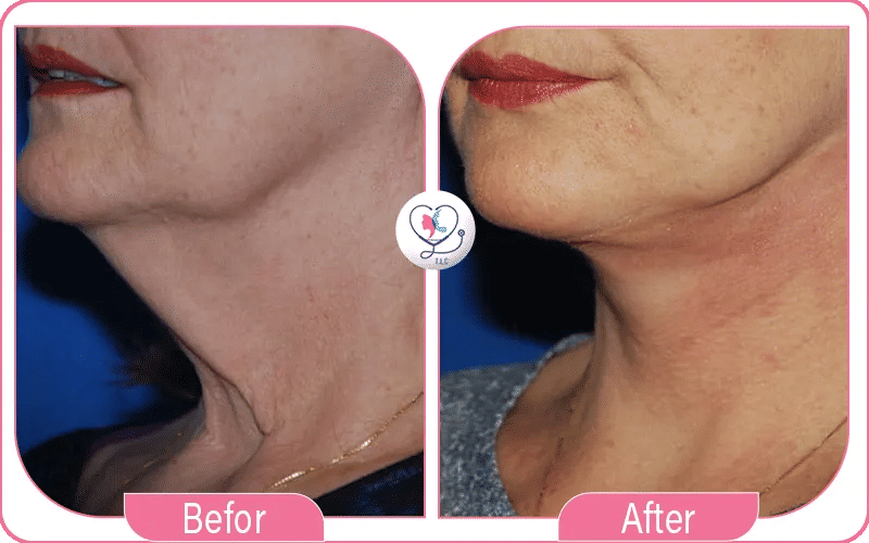 Neck Lift Recovery Pictures Day by Day