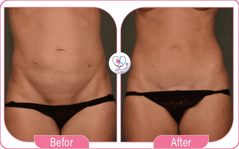 Belly Button Revision After Tummy Tuck Before and After