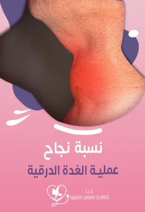 نسبة نجاح عملية الغدة الدرقية:  95 - 98% في معظم الحالات