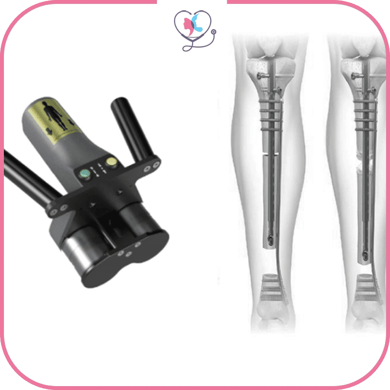 مميزات تطويل العظام باستخدام تقنية برسايس 2