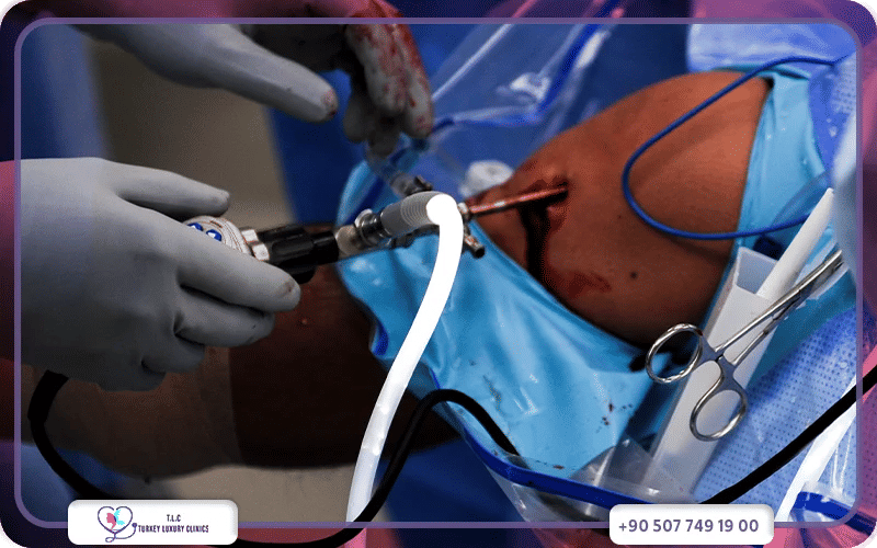 التحضير قبل عملية الرباط الصليبي بالمنظار