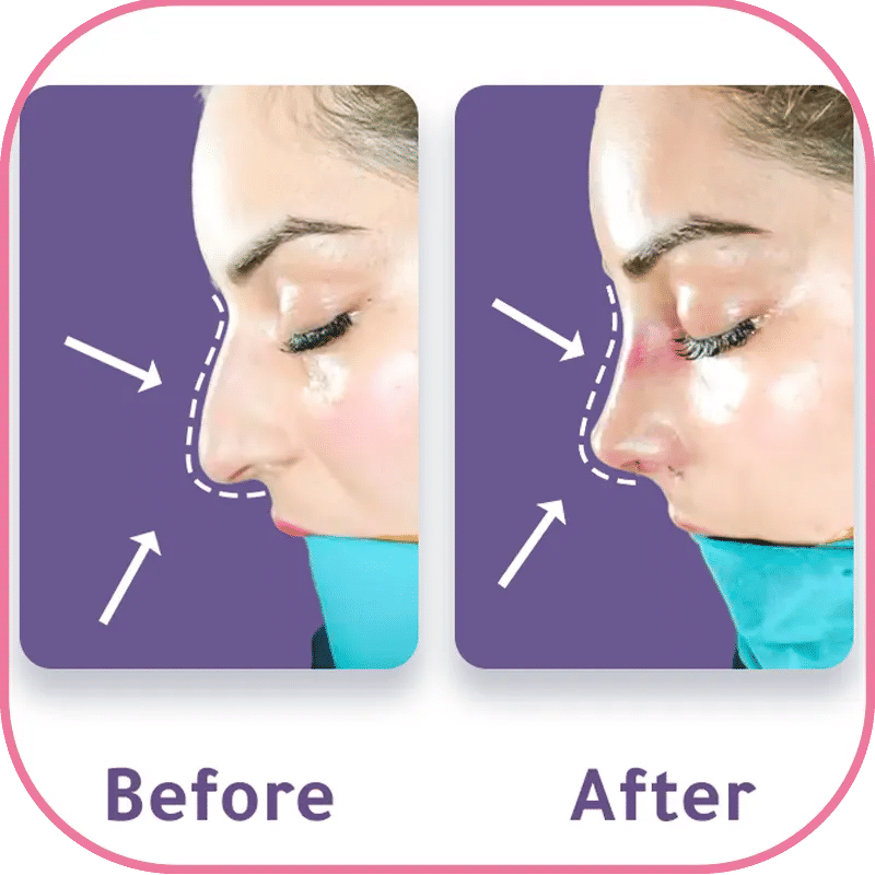 Défauts persistants ou nouveaux sur l'arête nasale (Dorsum)