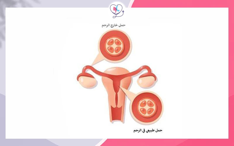 الحمل خارج الرحم