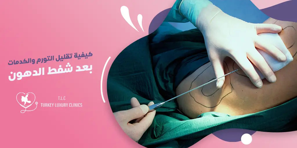 كيفية تقليل التورم والكدمات بعد شفط الدهون؟