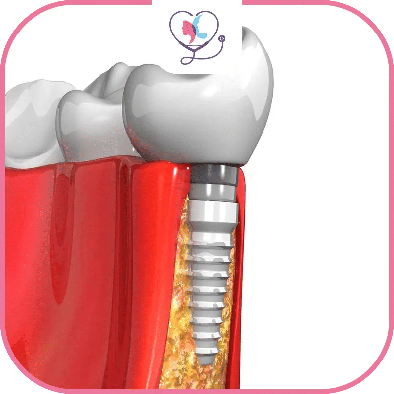 la-pose-d'implant-dentaire-représente-elle-un-risque-?