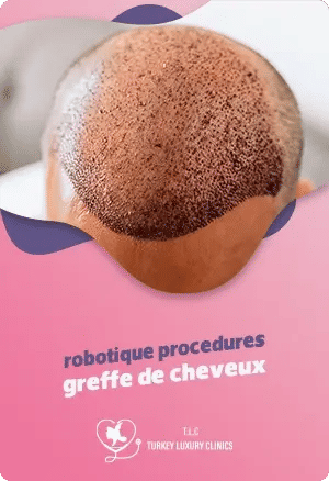 Avantages et inconvénients de la robotique dans les procédures de greffe de cheveux