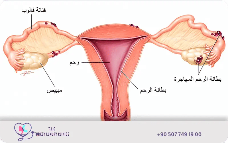 هل بطانة الرحم المهاجرة تسبب الوفاة؟