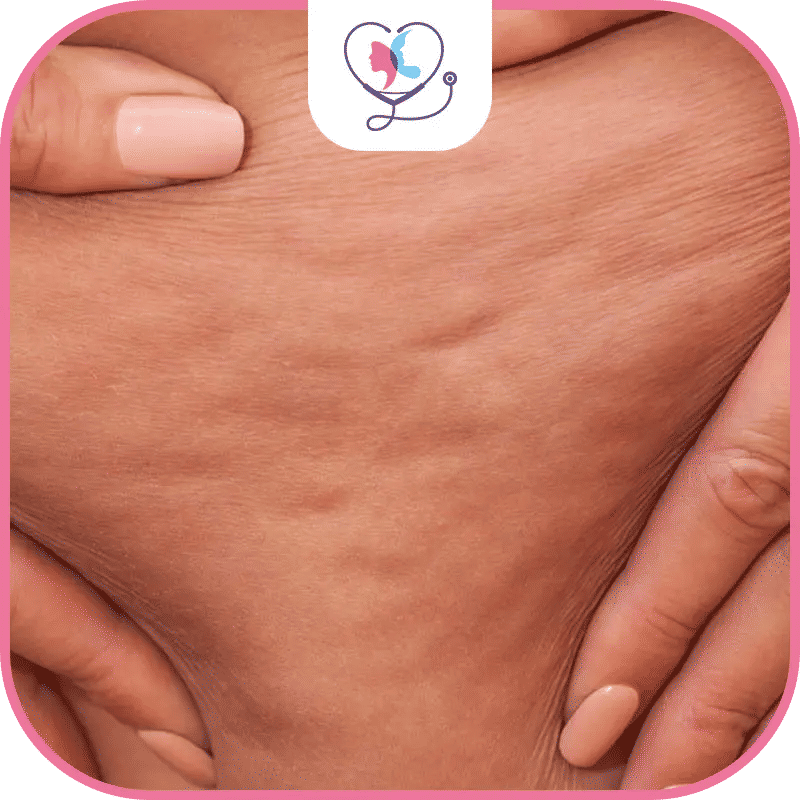 Aspect cellulite après liposuccion