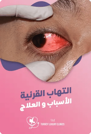 التهاب القرنية: الأسباب، الأعراض والعلاجfeatured image