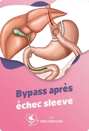 Bypass après échec sleeve : Solution de reprise efficace