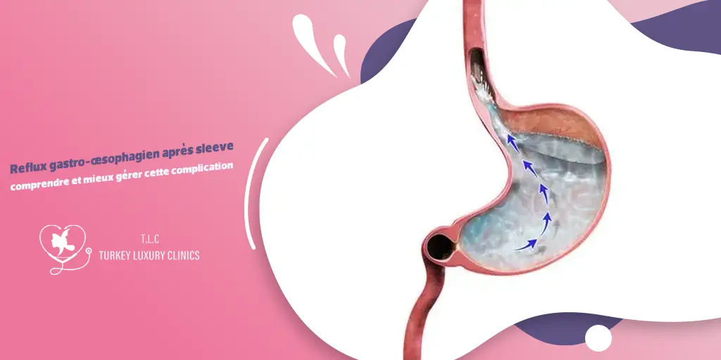 Reflux gastro-œsophagien après sleeve : comprendre et mieux gérer cette complication