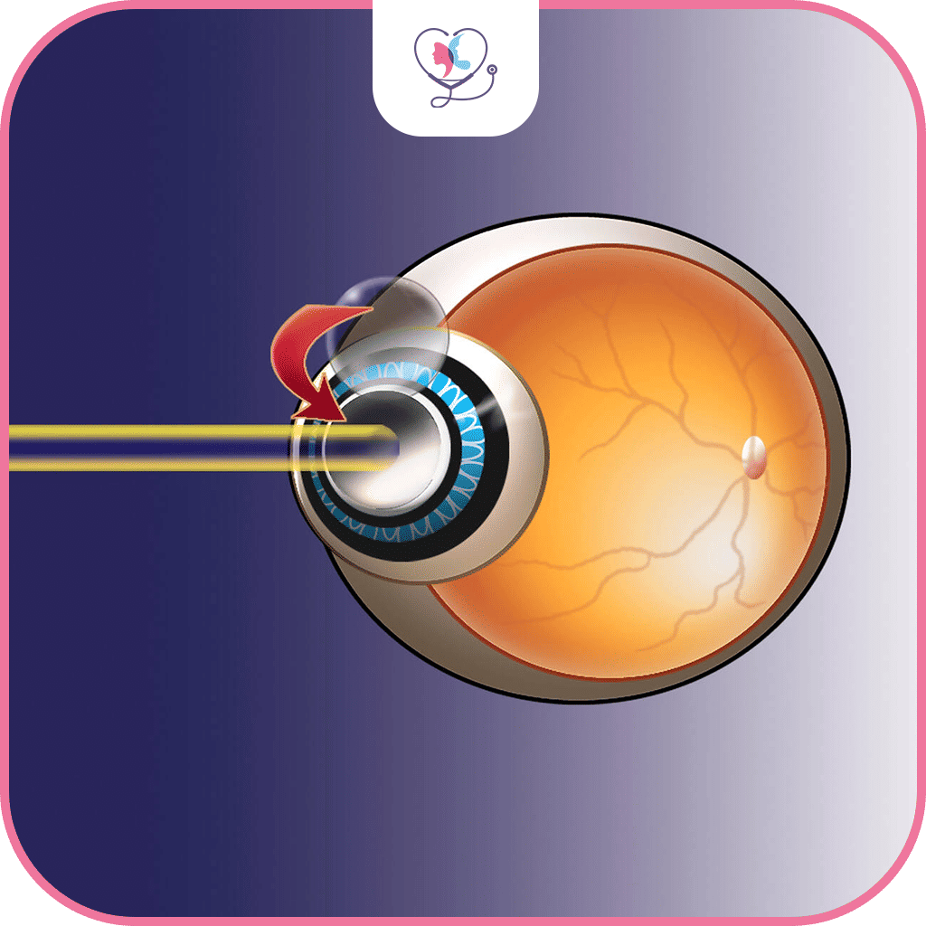 الفرق بين الليزك والفيمتو سمايل