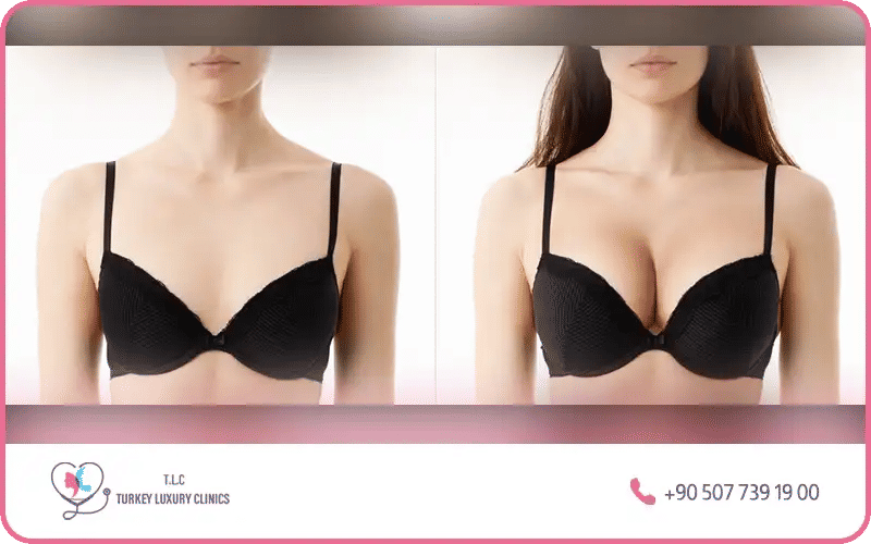 Résultats avant/après pour un bonnet G