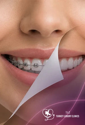 Clear Aligners vs Braces: Key Differences and Which Is Better