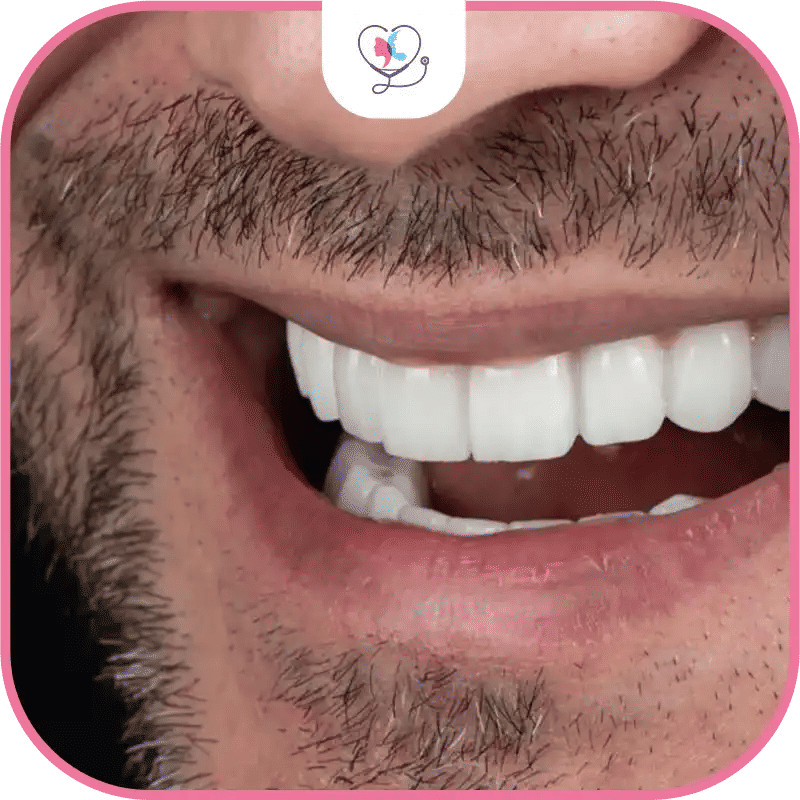 Disadvantages of Zirconia Implant