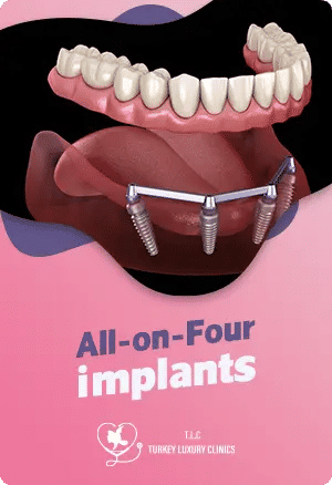 All-on-Four Implants: A Fixed Solution for Full Mouth Restoration.