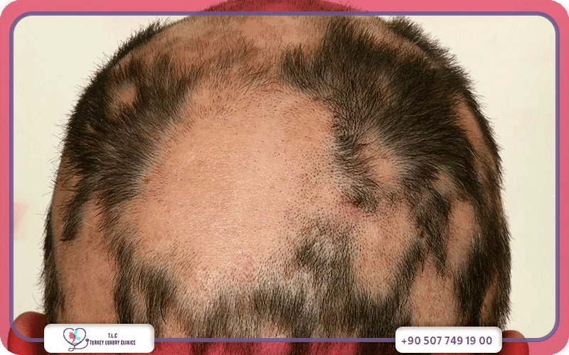 ما هو علاج الثعلبة في تركيا؟