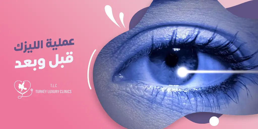 عملية الليزك قبل وبعد