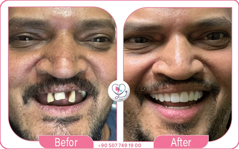 implant dentaire en turquie avant après
