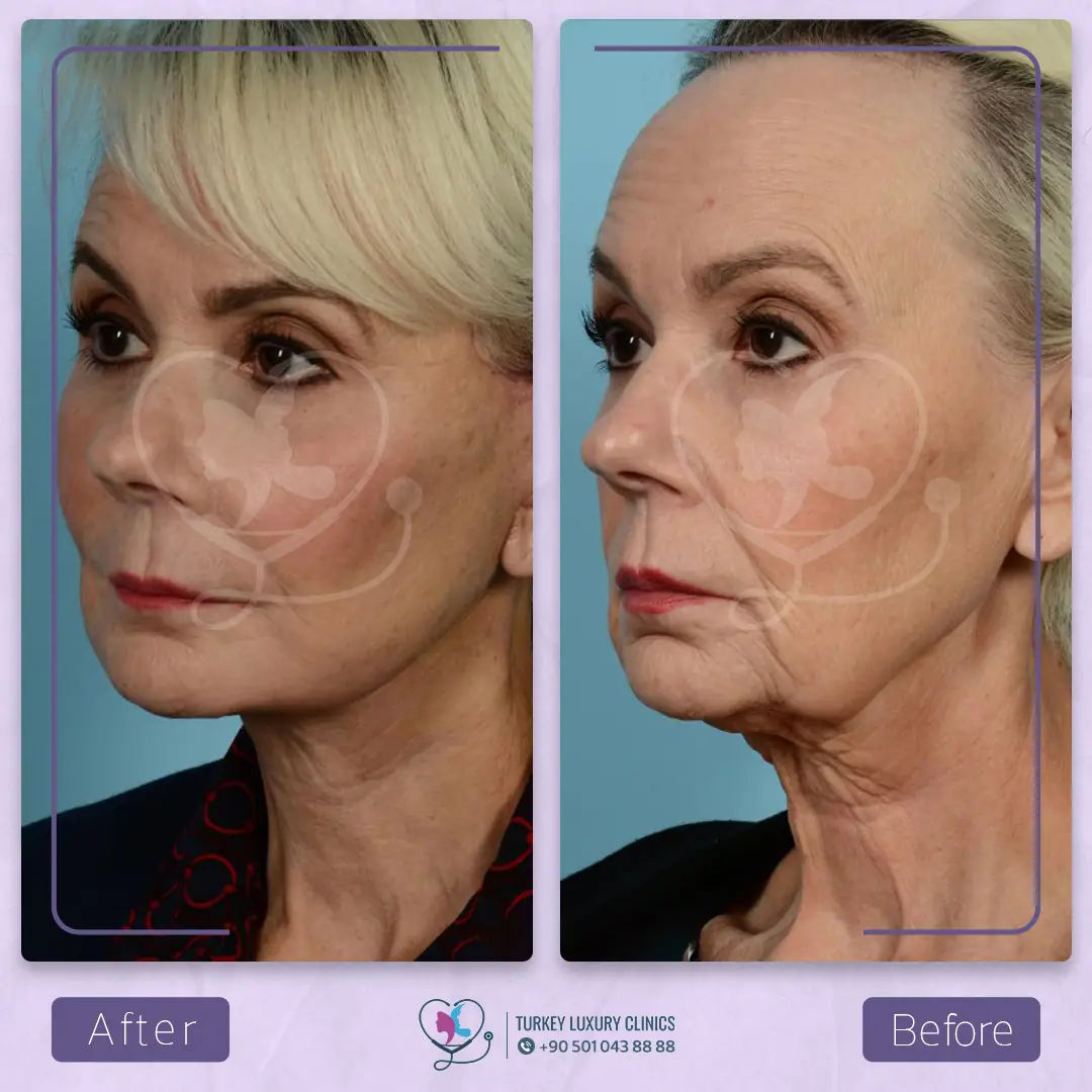 ما بعد عملية شد الوجه في تركيا