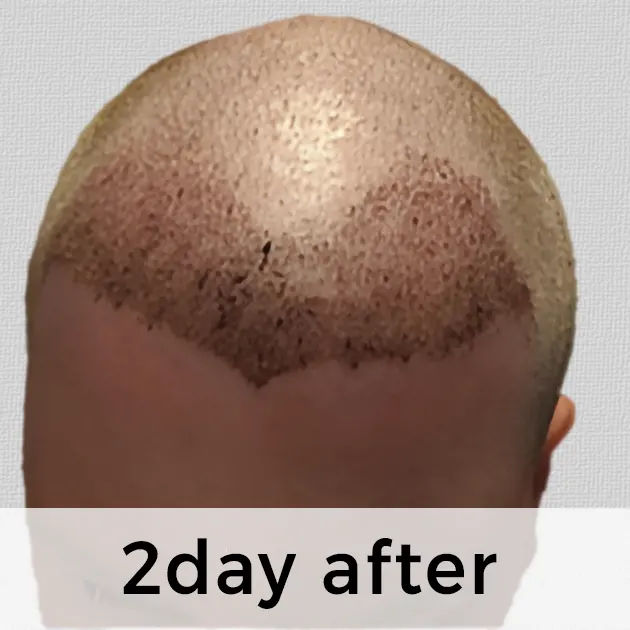 Hair Transplant Week by Week: From Week 1 to Week 48 