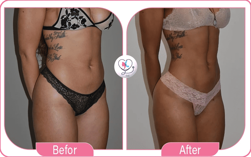 liposuccion ventre avant après femme