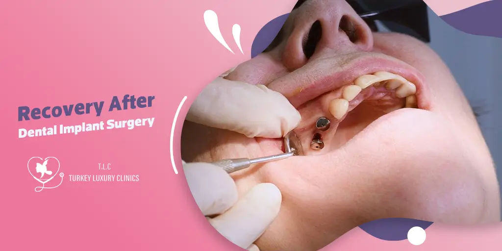 Recovery After Dental Implant Surgery: What to Expect and Tips for Smooth Healing