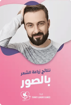 نتائج زراعة الشعر بالصورfeatured image