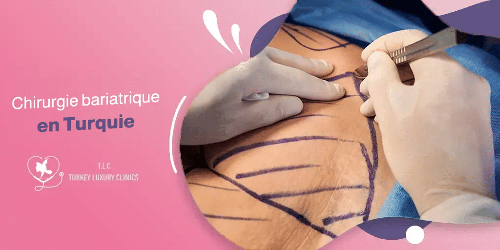 Chirurgie bariatrique en Turquie : Prix, procédures et avantages