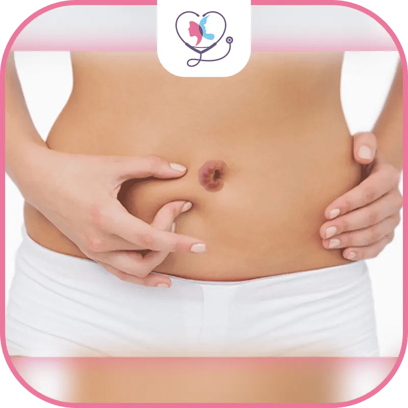 الم السرة بعد عملية شد البطن:الطبيعي وغير الطبيعي