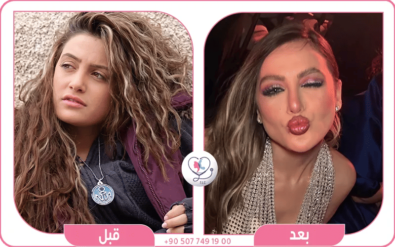 مرام علي قبل وبعد حقن الفيلر