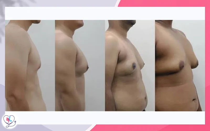 Severity and Tissue Type: Fat, Gland or Both