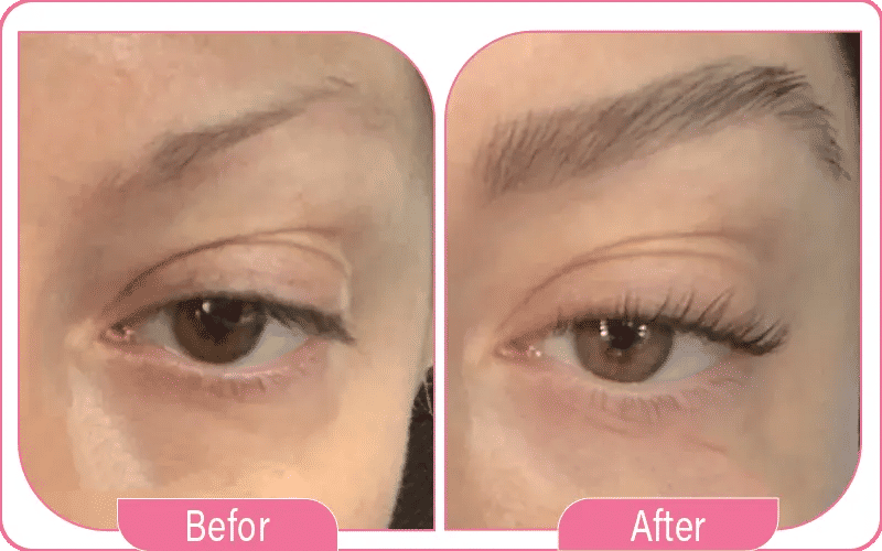 Eyebrow Transplant Before and After