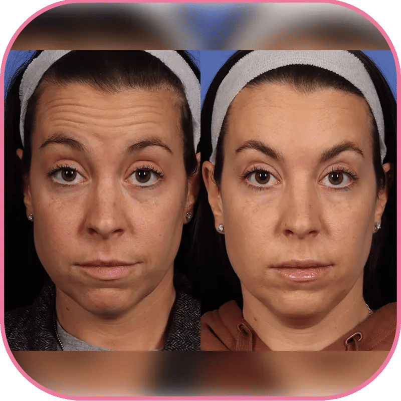 Botox Injection Before and After Photos