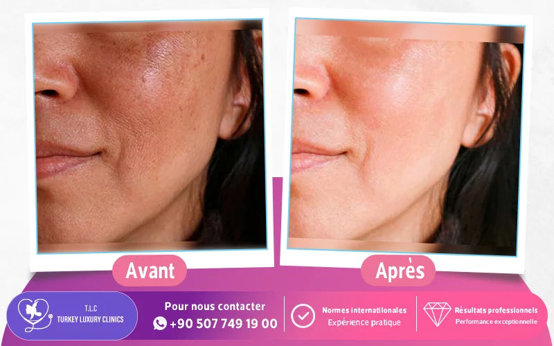 Photos avant / après mésothérapie du visage