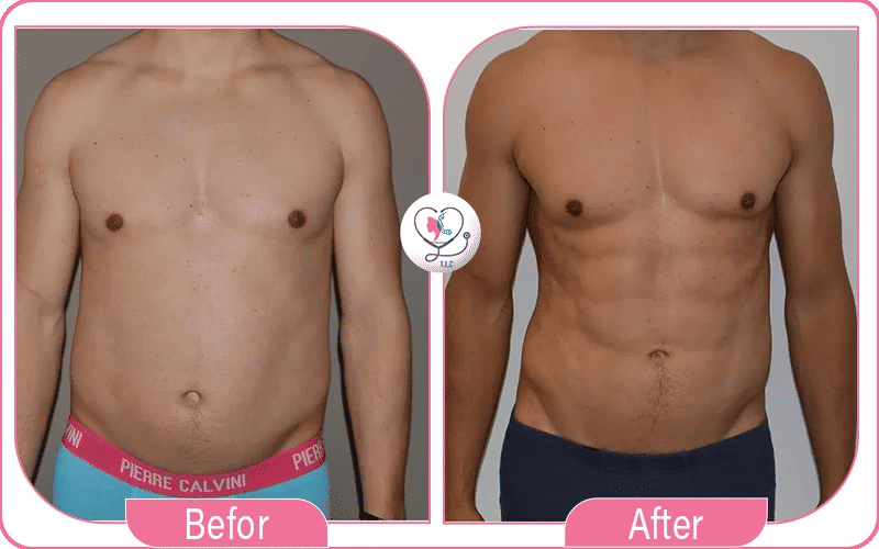 Male 360 Lipo with Tummy Tuck and Six Pack Definition Before & After
