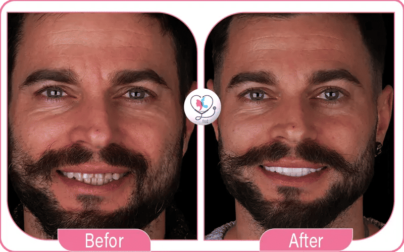 تجربتي مع تبييض الأسنان بالليزر في تركيا لاكشري كلينك